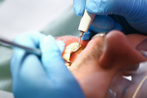 Best Emergency Dentist for Lost Fillings or Crowns in Fort Pierce North, FL