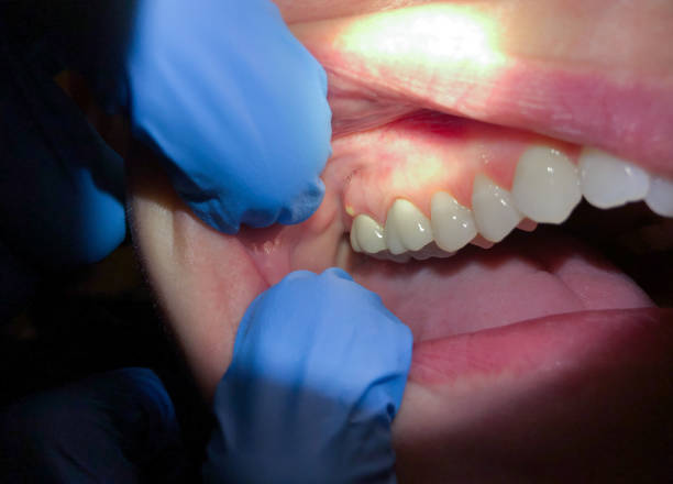 Best Emergency Dentist for Lost Fillings or Crowns in Fort Pierce North, FL